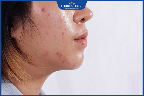 da dầu thâm mụn