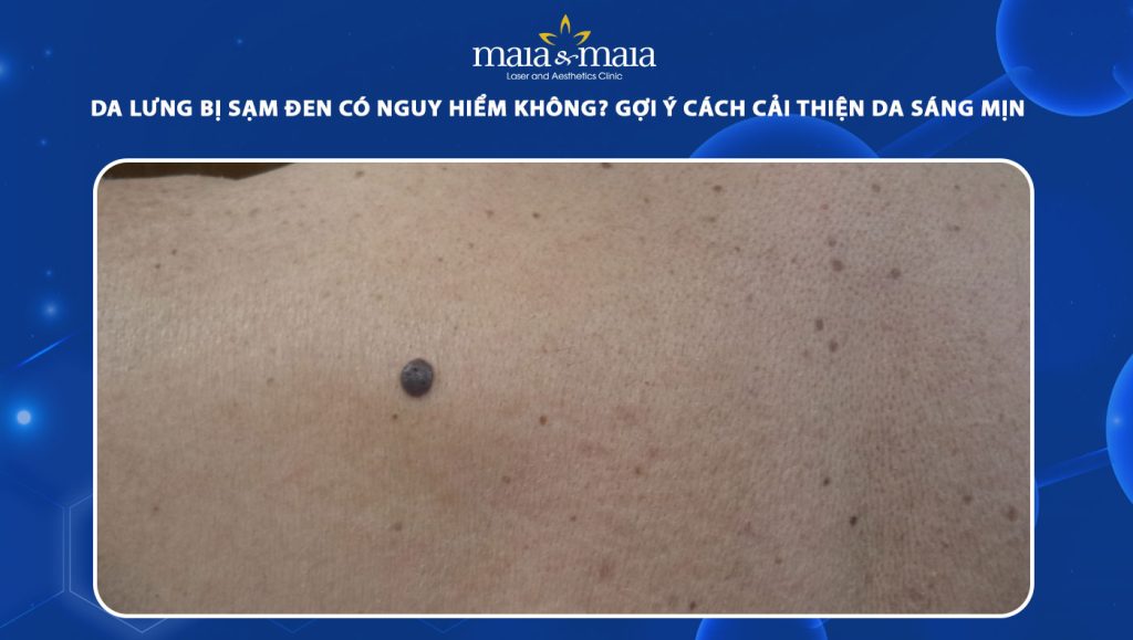 Da lưng bị sạm đen có nguy hiểm không? Cách cải thiện 1 da lưng bị sạm đen