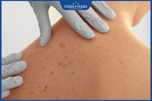 Da lưng bị sạm đen có nguy hiểm không? Cách cải thiện 2 da lưng bị sạm
