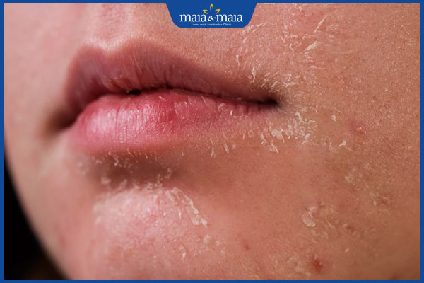 Cạo lông mặt bị ngứa do đâu? Cách xử lý hiệu quả và an toàn 2 da mặt khô