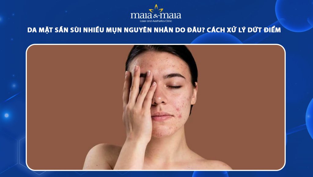 Da mặt sần sùi nhiều mụn do đâu? Cách xử lý dứt điểm 1 da mặt sần sùi nhiều mụn