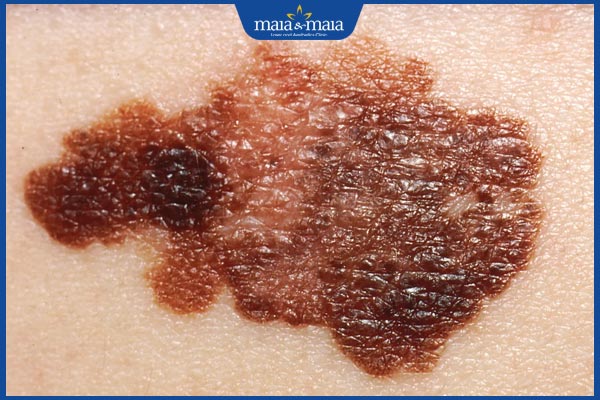 dấu hiệu ung thư da