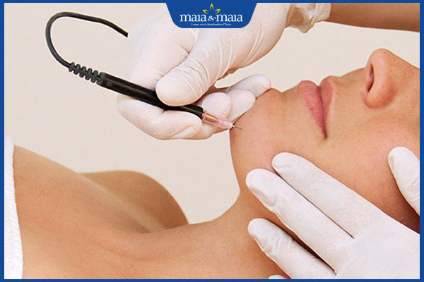 điện phân triệt ria mép