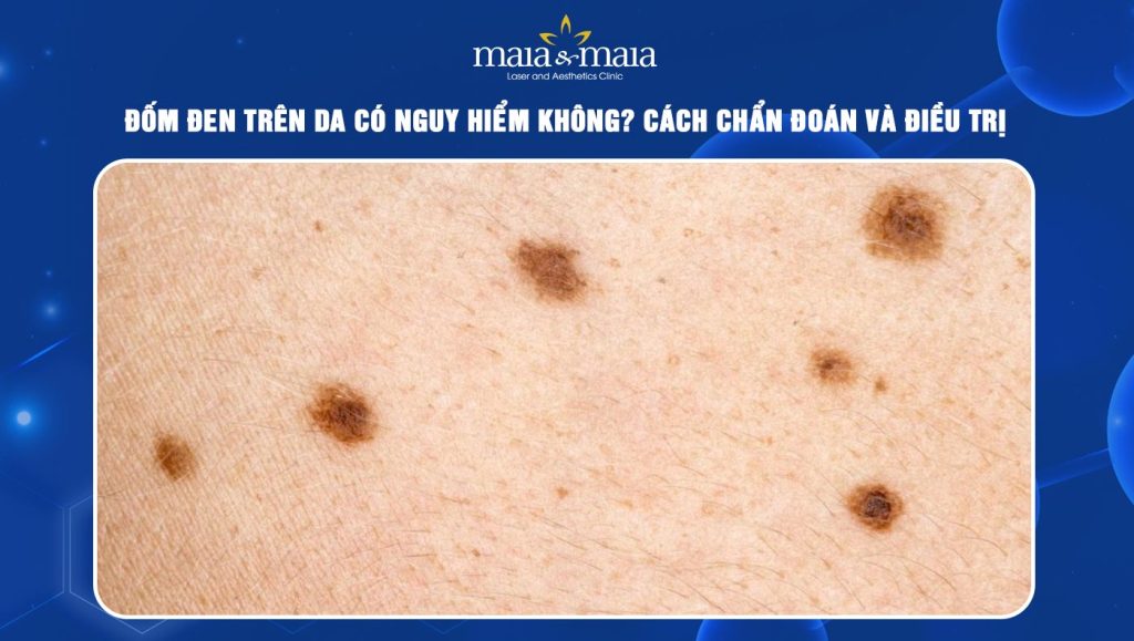 Đốm đen trên da