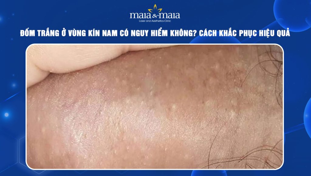 Đốm trắng ở vùng kín nam
