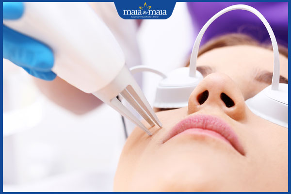 Trị thâm mụn bằng laser: Quy trình và chi phí thực hiện 2 dùng laser trị thâm mụn