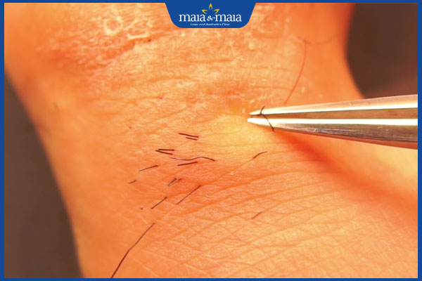 dùng nhíp nhổ lông chân ở ngón cái