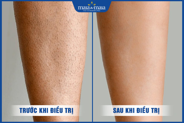 Nhổ lông chân tại nhà như thế nào? Rủi ro có thể gặp 5 hiệu quả triệt lông chân