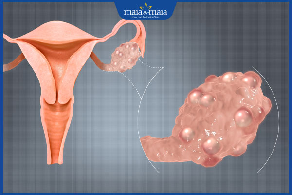Rậm lông do đa nang buồng trứng: Triệu chứng, cách khắc phục 2 hội chứng đa nang buồn trứng
