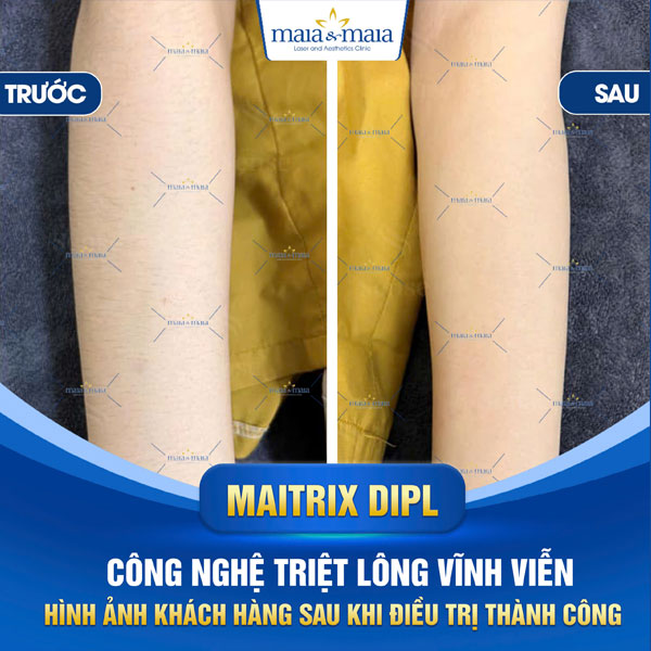 Các kỹ thuật triệt lông tay hiện nay và địa chỉ triệt uy tín 4 khách hàng triệt lông tay tại maia