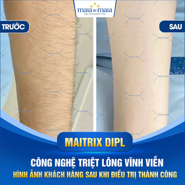 Các kỹ thuật triệt lông tay hiện nay và địa chỉ triệt uy tín 5 khách triệt lông tay