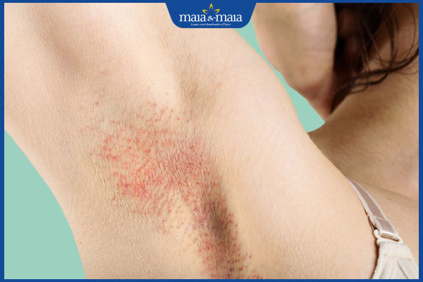 kích ứng nách nữ giới