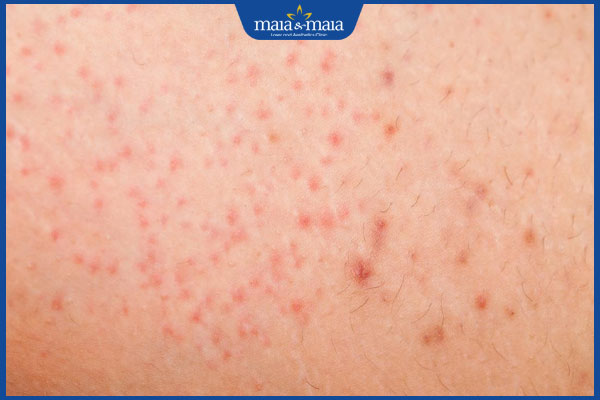 kích ứng sau cạo lông vùng kín