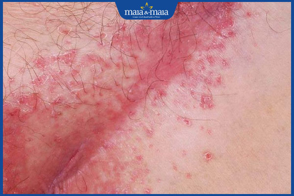 kích ứng sau triệt lông