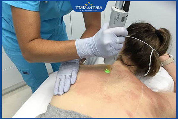 Da lưng bị sạm đen có nguy hiểm không? Cách cải thiện 3 laser trị sạm da lưng