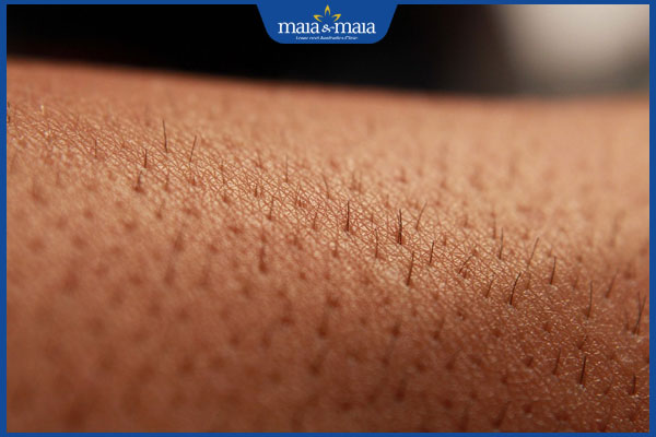 lông mọc lại sau triệt