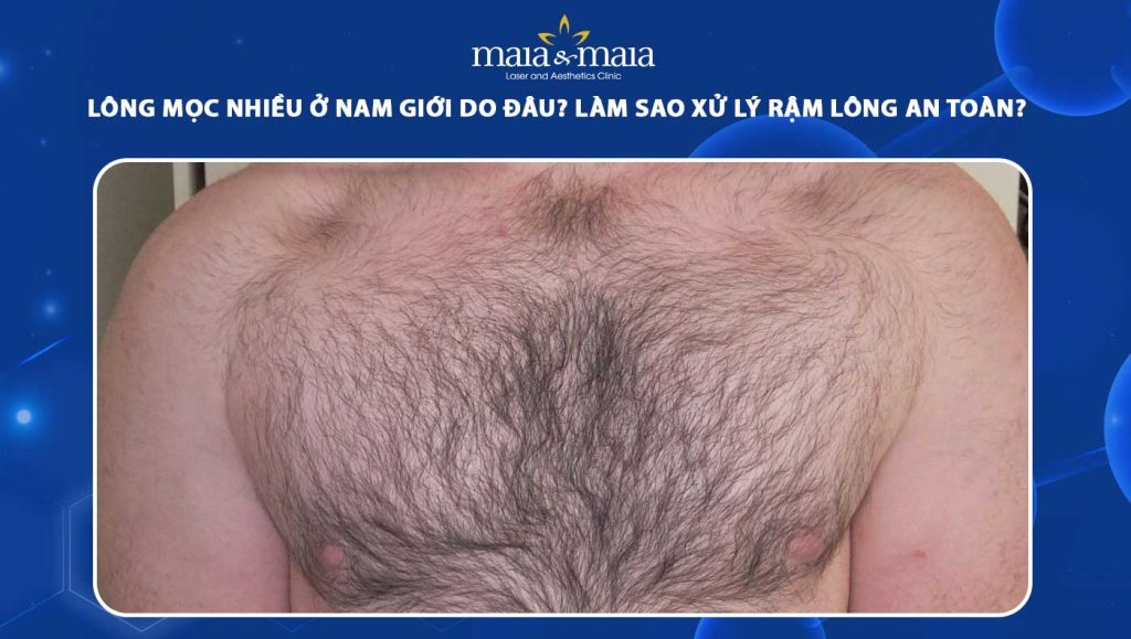 Lông mọc nhiều ở nam giới do đâu? Cách xử lý hiệu quả 1 lông mọc nhiều ở nam giới