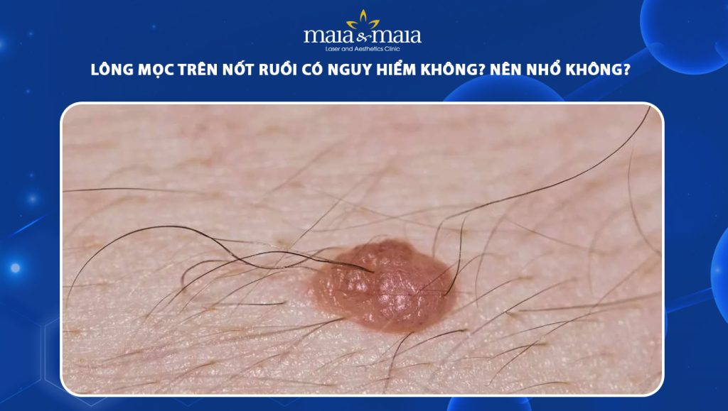 lông mọc trên nốt ruồi