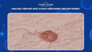 lông mọc trên nốt ruồi