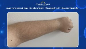 lông tay nhiều là giàu