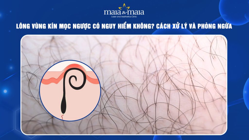 Lông vùng kín mọc ngược