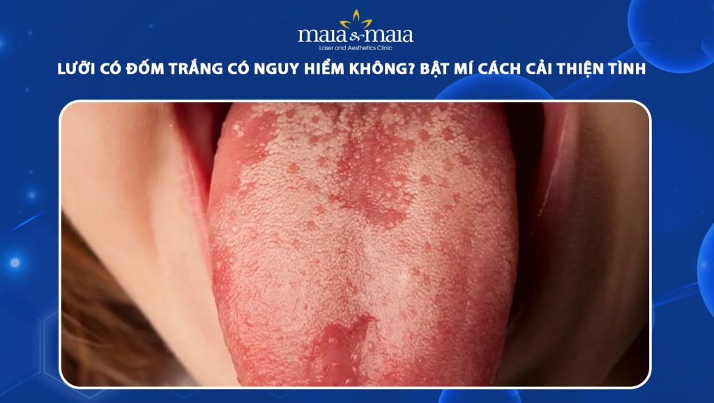 lưỡi có đốm trắng