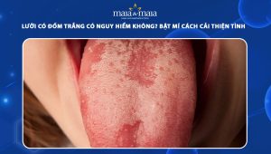 lưỡi có đốm trắng