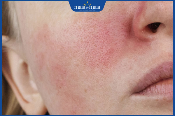 mặt bị kích ứng