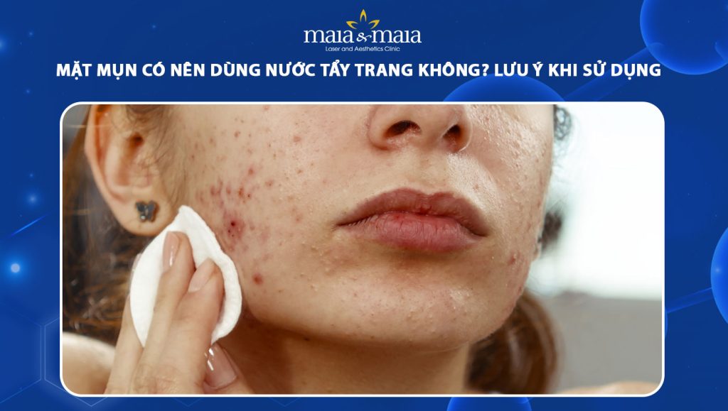 mặt mụn có nên dùng nước tẩy trang