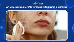 mặt mụn có nên dùng nước tẩy trang