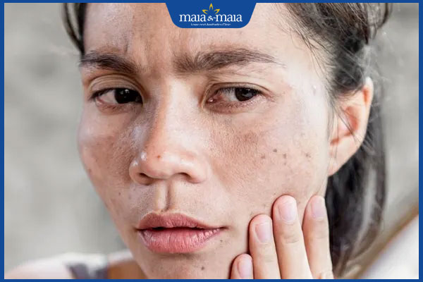 mặt nổi đốm đen