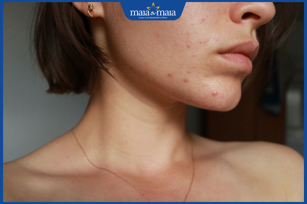 Thâm mụn bao lâu thì hết? Cách xóa thâm dứt điểm, hiệu quả 2 mặt thâm do mụn