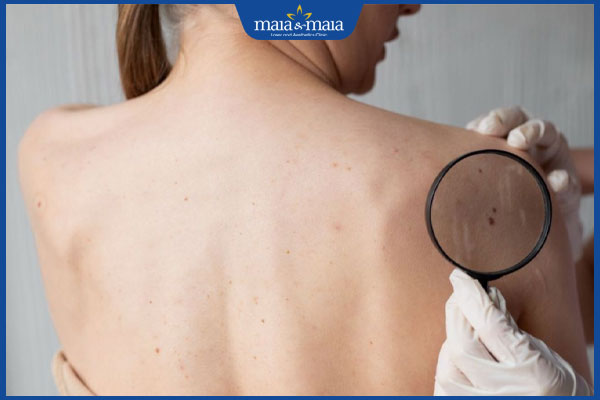 mọc nốt ruồi thăm khám bác sĩ