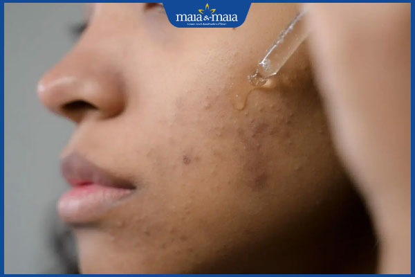 mức độ thâm mụn