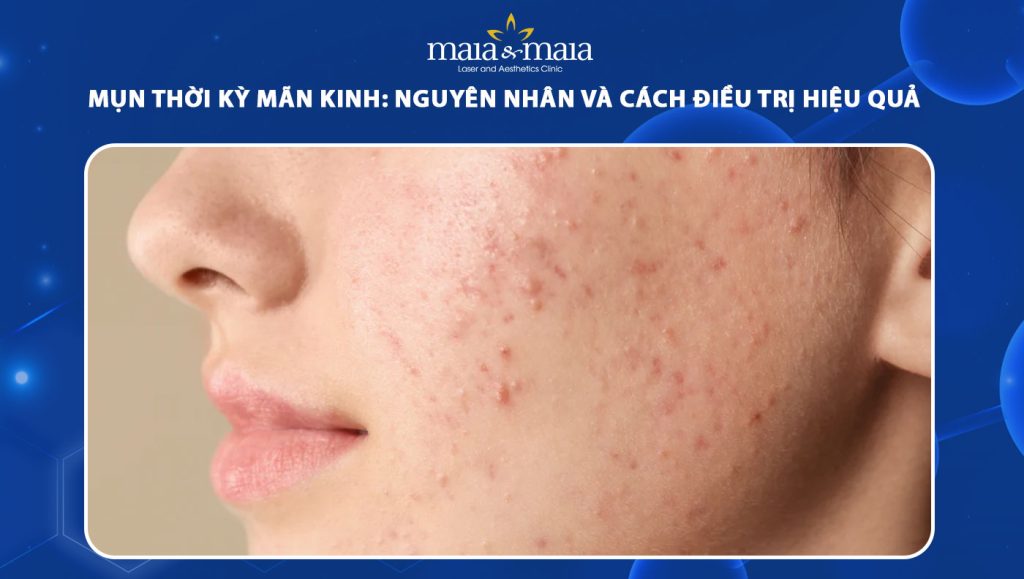 Mụn thời kỳ mãn kinh: Nguyên nhân và cách điều trị hiệu quả 1 mụn thời kỳ mãn kinh