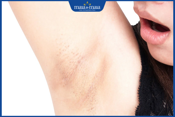 nách ngứa rát sau tẩy lông