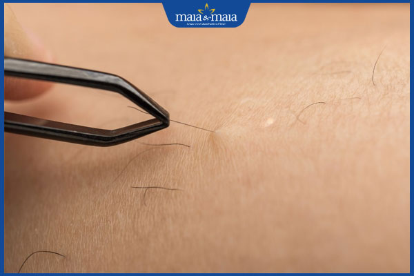 nhổ lông bikini bằng nhíp