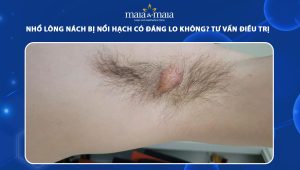 nhổ lông nách bị nổi hạch