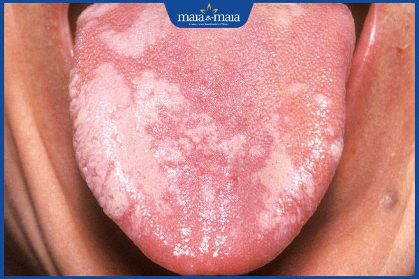 nổi đốm trắng ở lưỡi