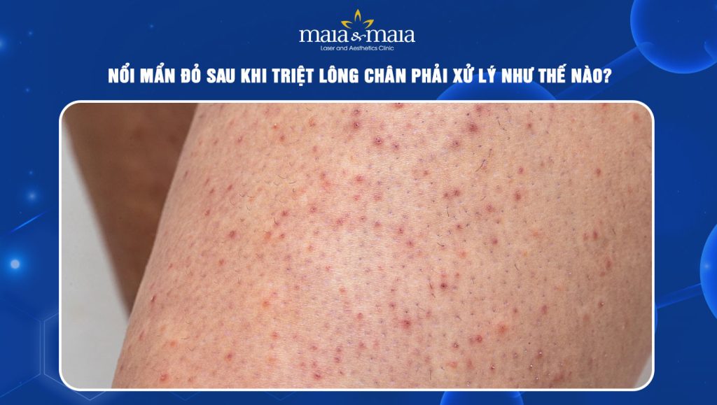Nổi mẩn đỏ sau khi triệt lông chân