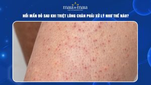 Nổi mẩn đỏ sau khi triệt lông chân