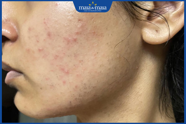 nổi mụn sau triệt lông mặt