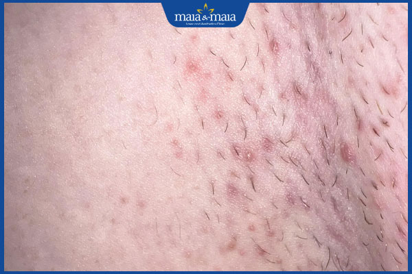 nổi mụn vùng kín sau cạo lông