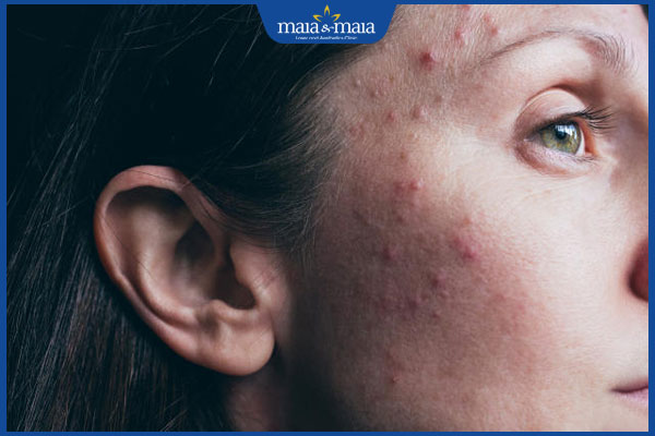 Mụn thời kỳ mãn kinh: Nguyên nhân và cách điều trị hiệu quả 2 phụ nữ mọc mụn thời mãn kinh