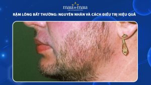 rậm lông bất thường