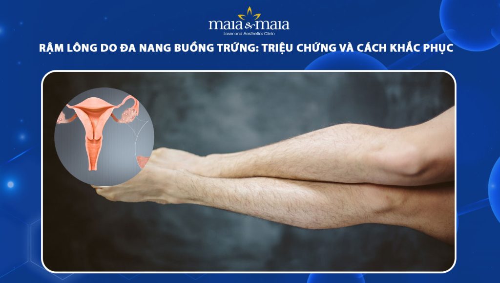 Rậm lông do đa nang buồng trứng: Triệu chứng, cách khắc phục 1 rậm lông do đa nang buồng trứng