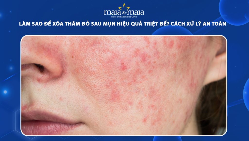 thâm đỏ sau mụn