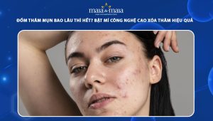thâm mụn bao lâu thì hết