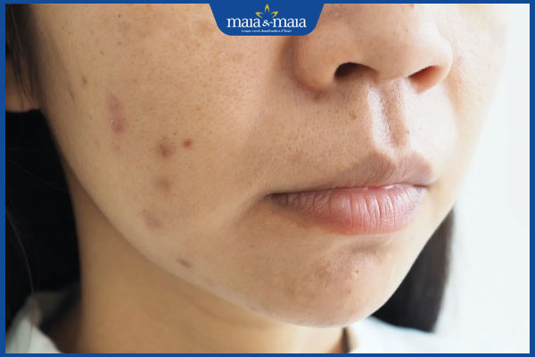 Trị thâm mụn bằng laser: Quy trình và chi phí thực hiện 4 thâm mụn