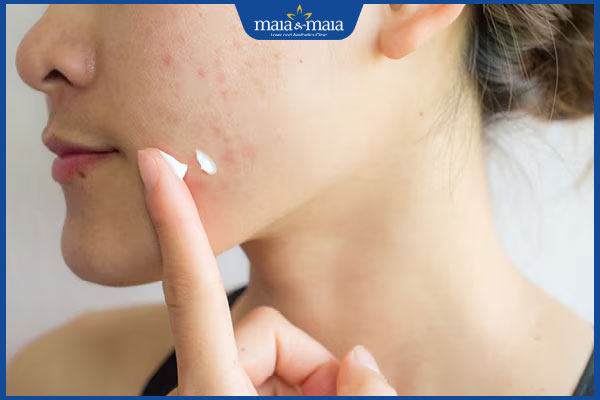 thoa vitamin e lên vết thâm mụn